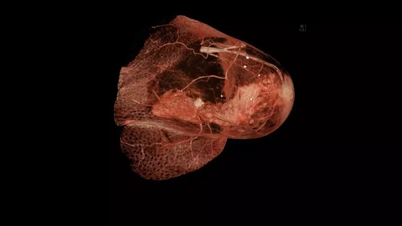 Так выглядит раковая опухоль на снимке КТ груди