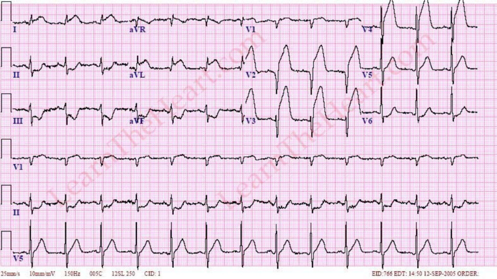 Так выглядит электрокардиограмма пациента с инфарктом миокарда с подъемом сегмента ST.
