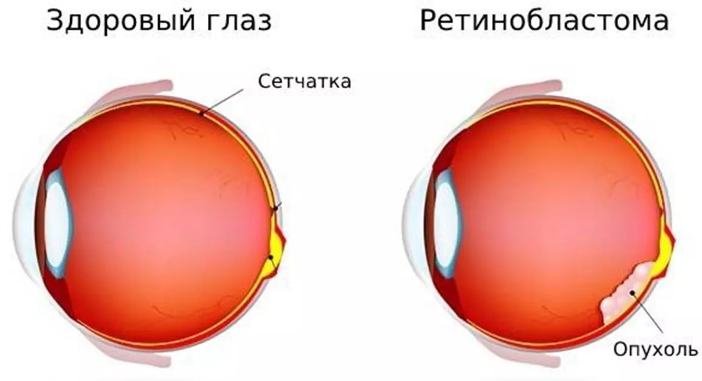 Изображение здорового глаза и ретинобластомы