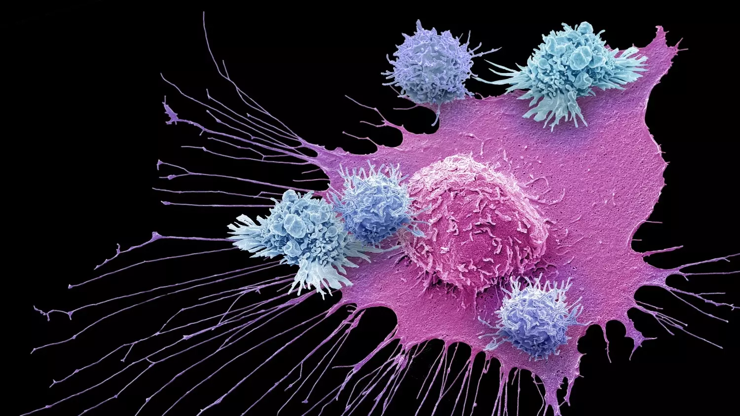 примерно так выглядит под микроскопом клеточная аутоиммунная терапия рака молочной железы